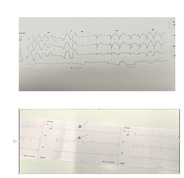 ECG of VT and Brugada signs